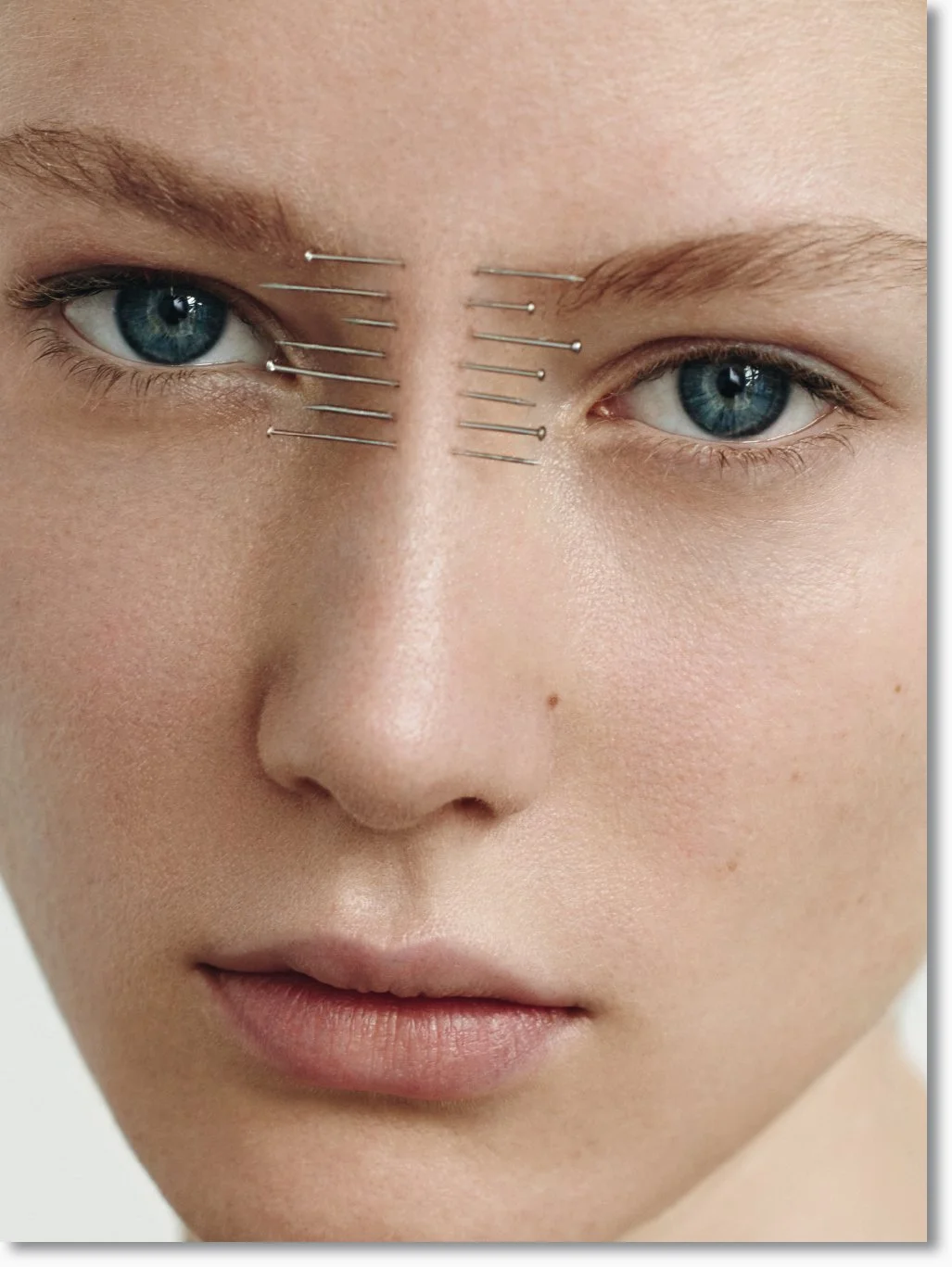 Nahaufnahme eines Gesichtes mit 14 Nadelpunkten im Bereich der Stirn und Augenbrauen.
