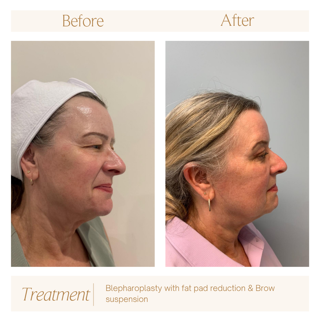 Blepharoplasy with fat pad reduction & Brow suspension.png