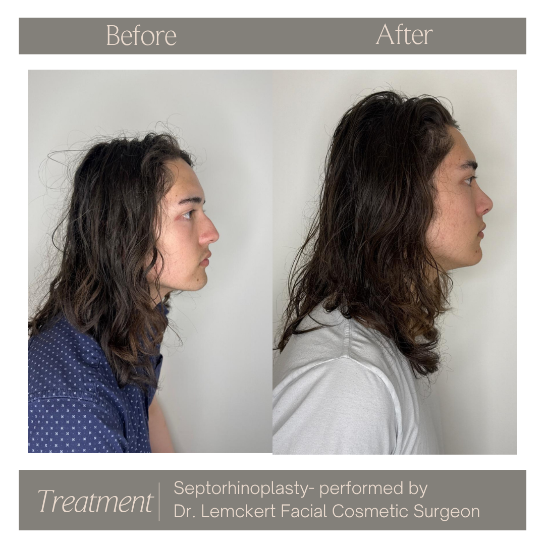 Facelift, Necklift & Platysma Plasty.png