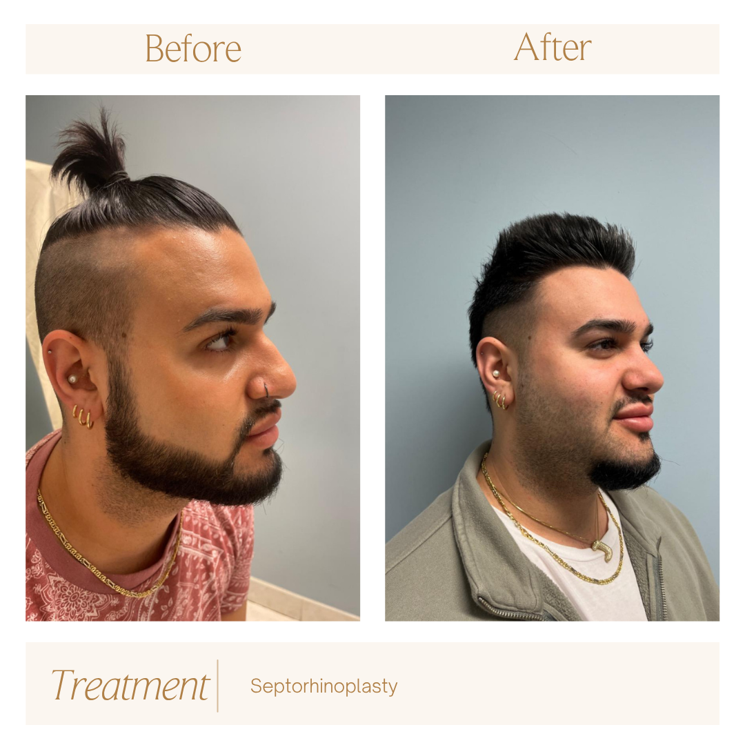 Septorhinoplasty (2).png