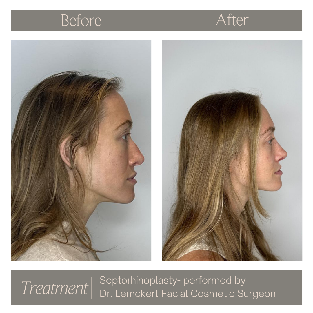 Facelift, Necklift & Platysma Plasty.png