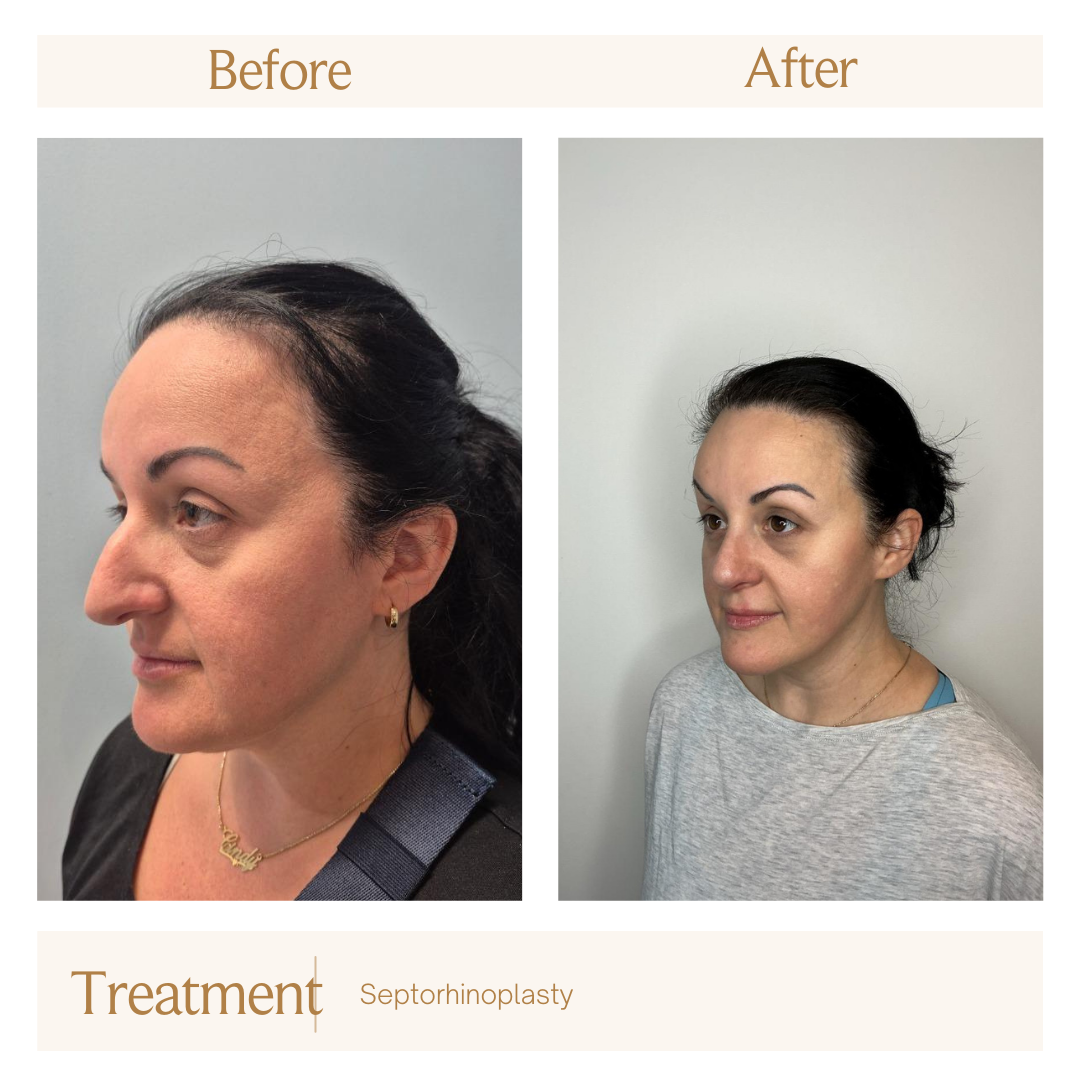 Septorhinoplasty.png