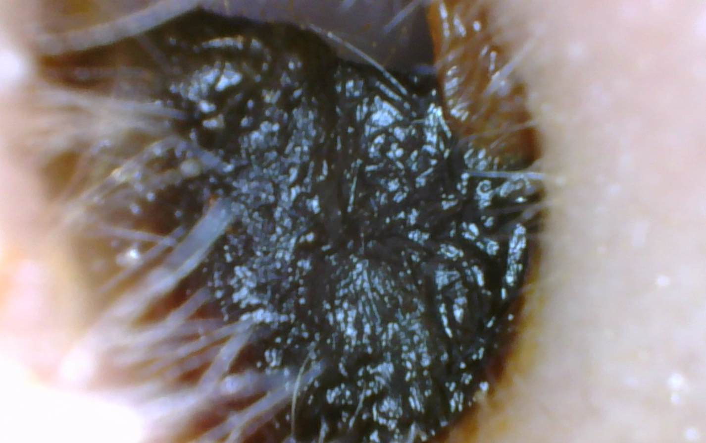 Ear blocked with earwax. Blocked ear canal.