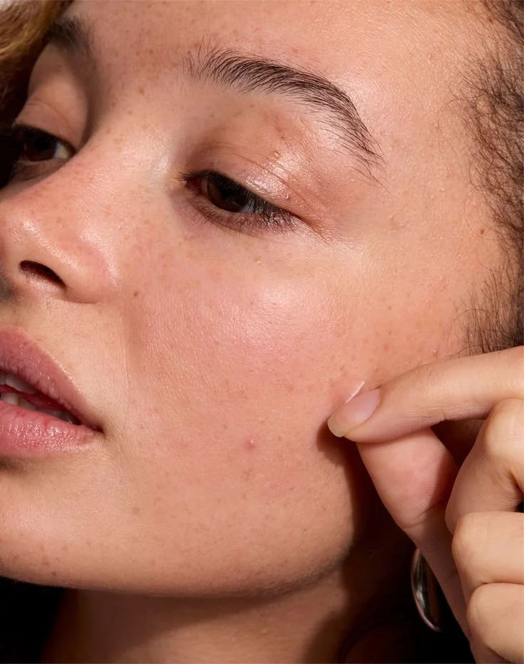 Common (And Overlooked) Acne Triggers