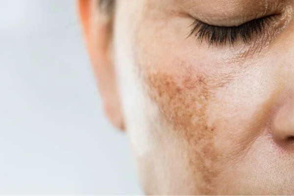 How to Actually Treat Pigmentation (Not Just Cover It)