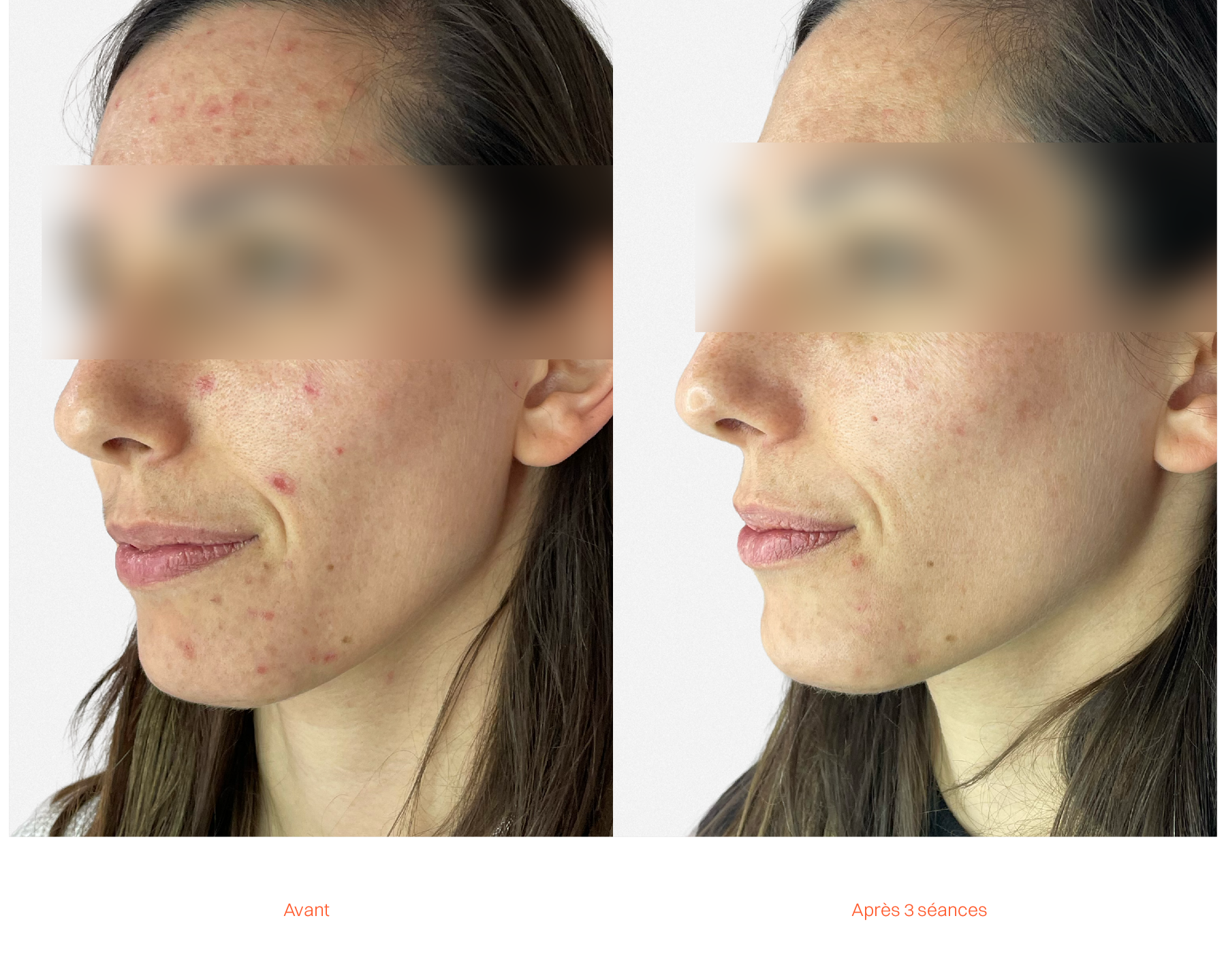 Laseo_AvantApres_Siteinternet_HollywoodPeeling_03.png