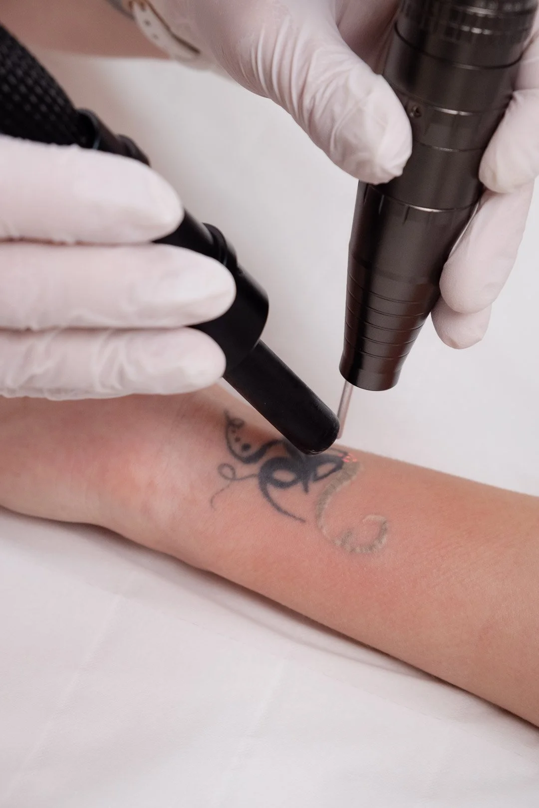 Détatouage au laser avec un flux d'air froid pour anesthésier la zone traitée, réalisé à Bulle à la clinique de médecine esthétique Laseo dans le canton de Fribourg.