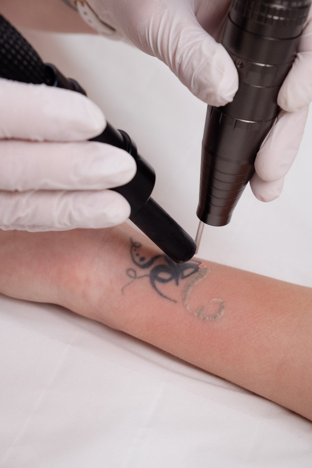 Détatouage laser réalisé à la clinique Laseo à Bulle à l'aide du laser médical Hollywood Spectra de Lutronic en Suisse.