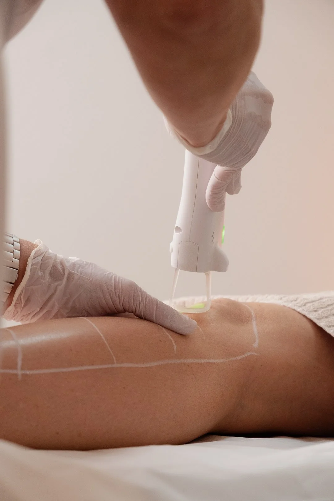 Epilation définitive au laser médical réalisée à la clinique de médecine esthétique Laseo à Bulle, dans le canton de Fribourg