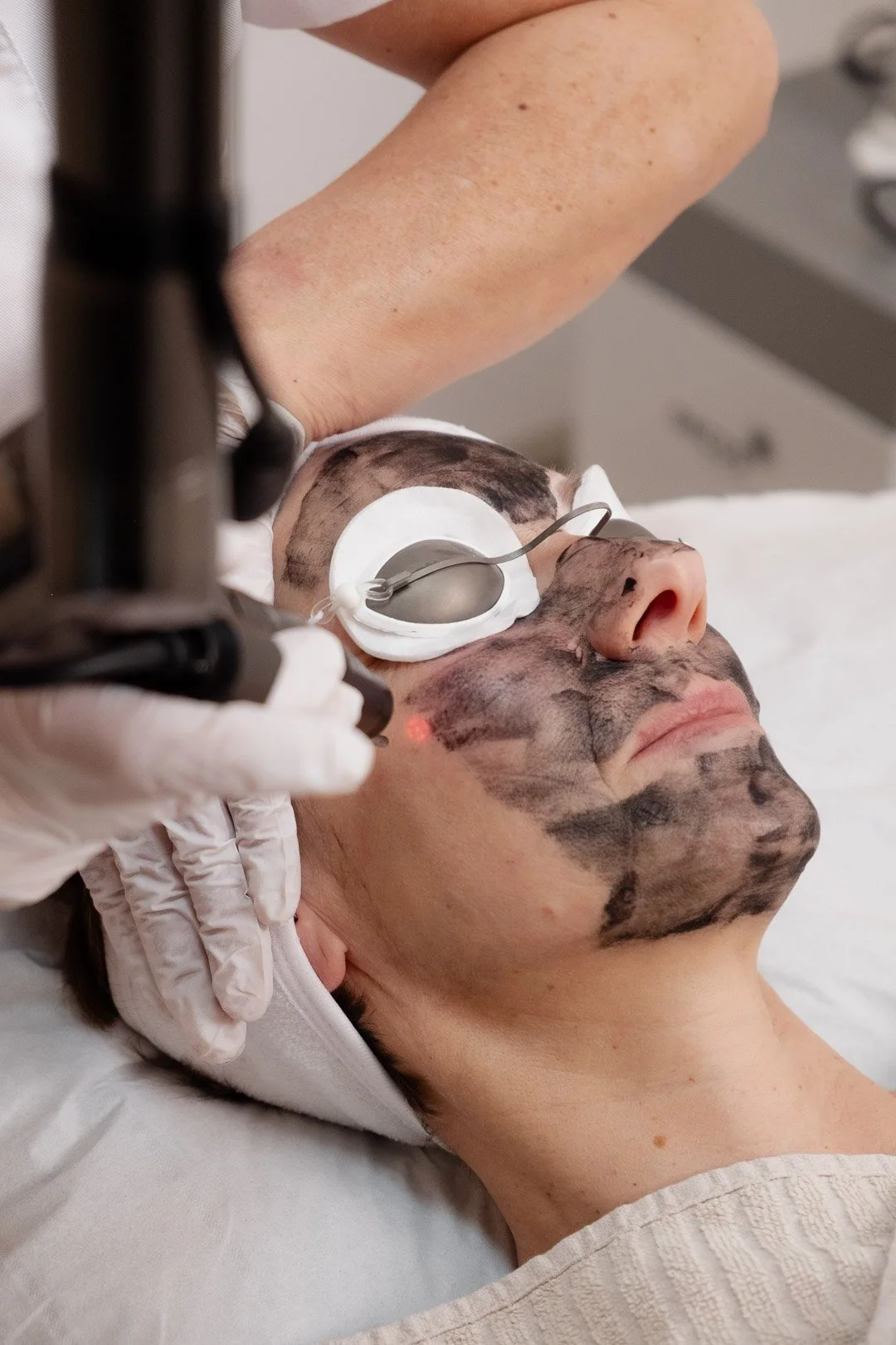 Le Hollywood Peeling par Hollywood Spectra est un peeling dermatologique effectué avec un laser médical esthétique dans la clinique Laseo à Bulle, en suisse Romande.