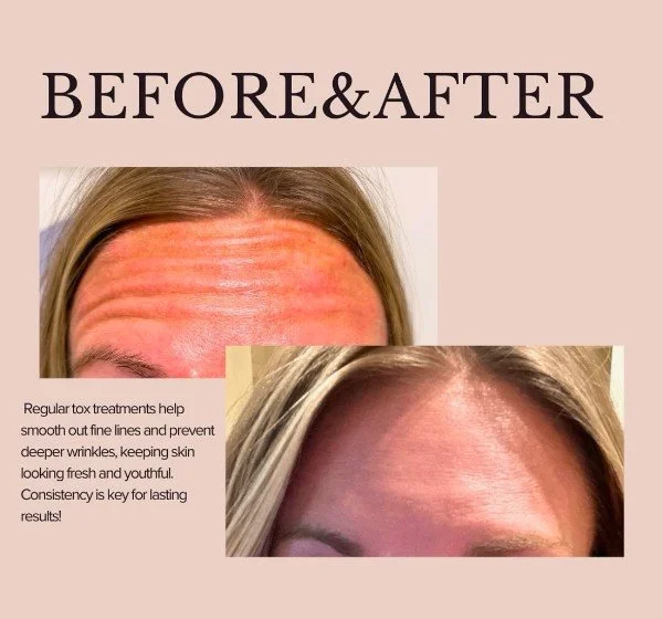 Comparison of a forehead before and after treatment, showing reduced wrinkles. Text highlights benefits of regular tox treatments for smooth and youthful skin.