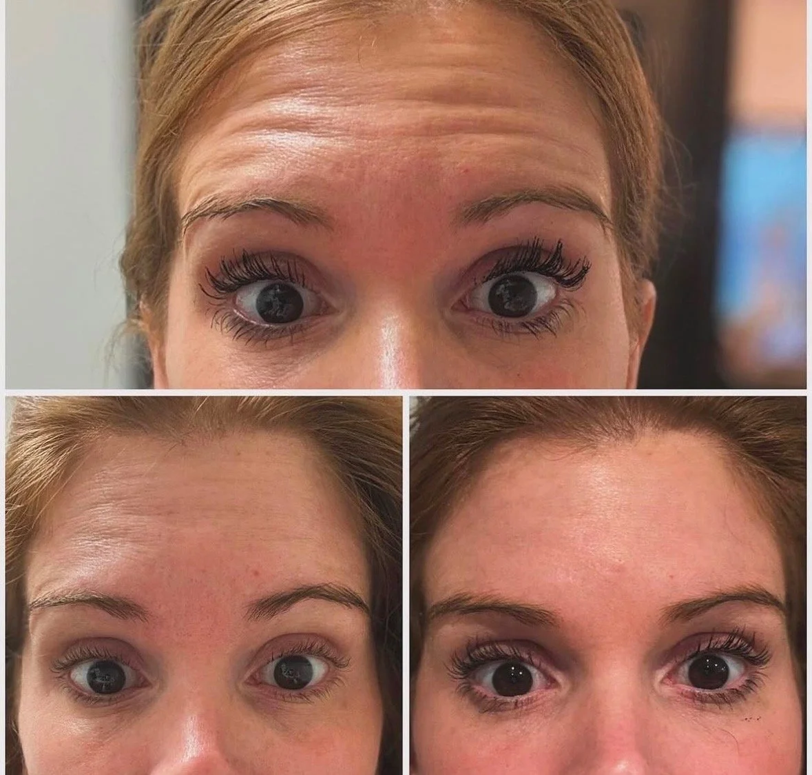 Close-up images of a woman's face focusing on her forehead and eyes, showing different expressions and wrinkles on the forehead.