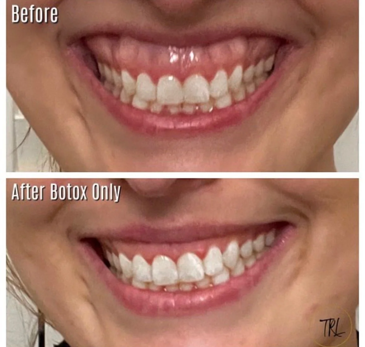Comparison of a smile before and after Botox treatment, showing reduced gum exposure.