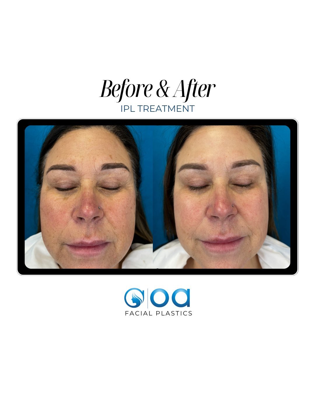 Say goodbye to redness, dark spots, and dull skin with IPL! 🌟

Intense Pulsed Light (IPL) treatments at OAFP are a go-to solution for reducing sun damage, redness, and uneven skin tone. 

Our latest before and after speaks volumes; brighter, clearer