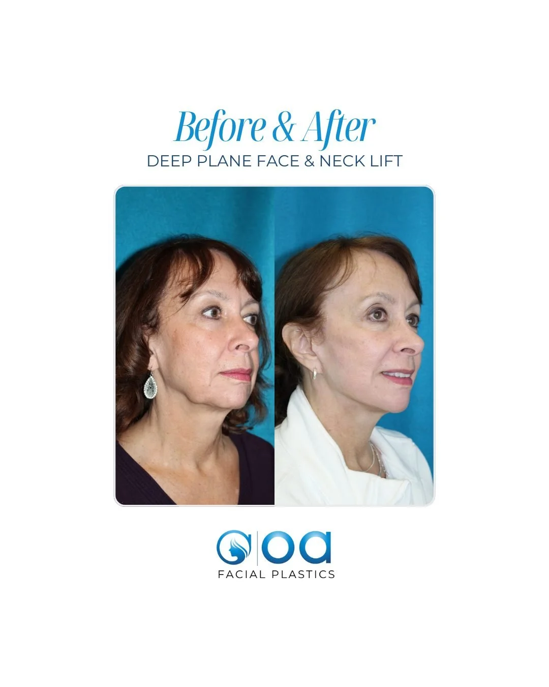 This patient is about 2 months post a deep plane face &amp; neck lift combined with a 35% TCA peel. 

The lift restores structure and support, while the peel smooths texture and evens tone. 

Most surgical recovery is about 1&ndash;2 weeks, and the p