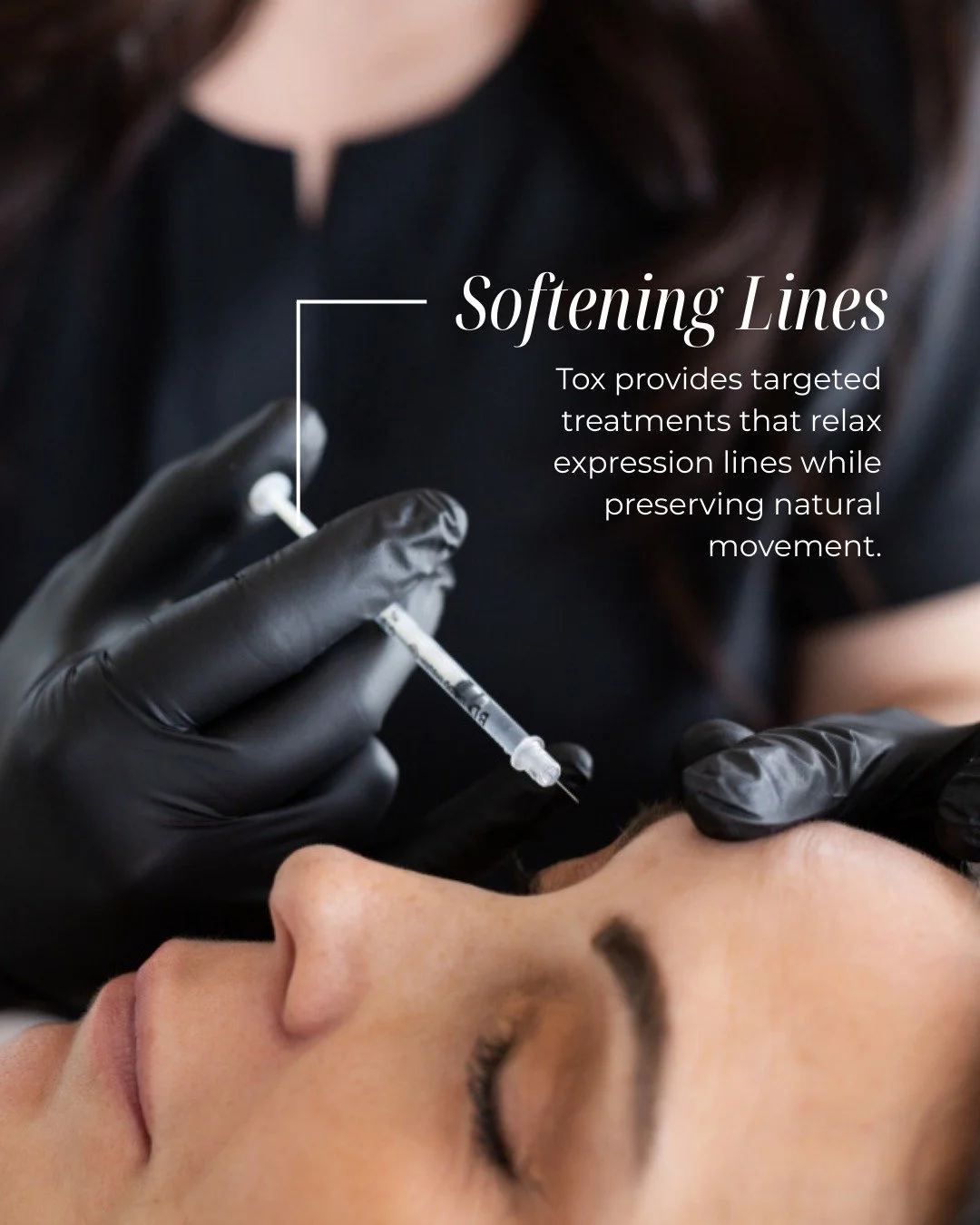 Subtle doesn&rsquo;t mean ineffective. At OA Facial Plastics, our tox treatments are designed to soften lines caused by repeated facial movement, so you look refreshed (not frozen 😉).

When placed thoughtfully, results look natural and still feel li