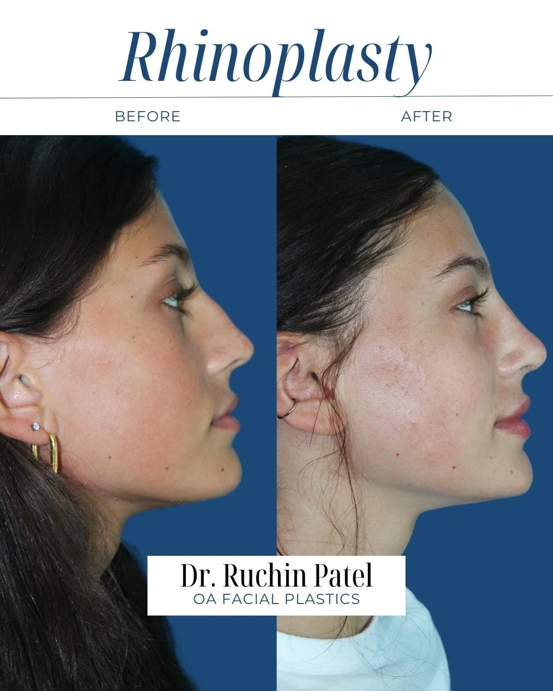 This is a patient who came to Dr. Patel with breathing concerns but also had a dorsal hump that bothered her.  She underwent functional nasal surgery to improve her breathing and had a cosmetic dorsal hump reduction at the same time. 

These results 