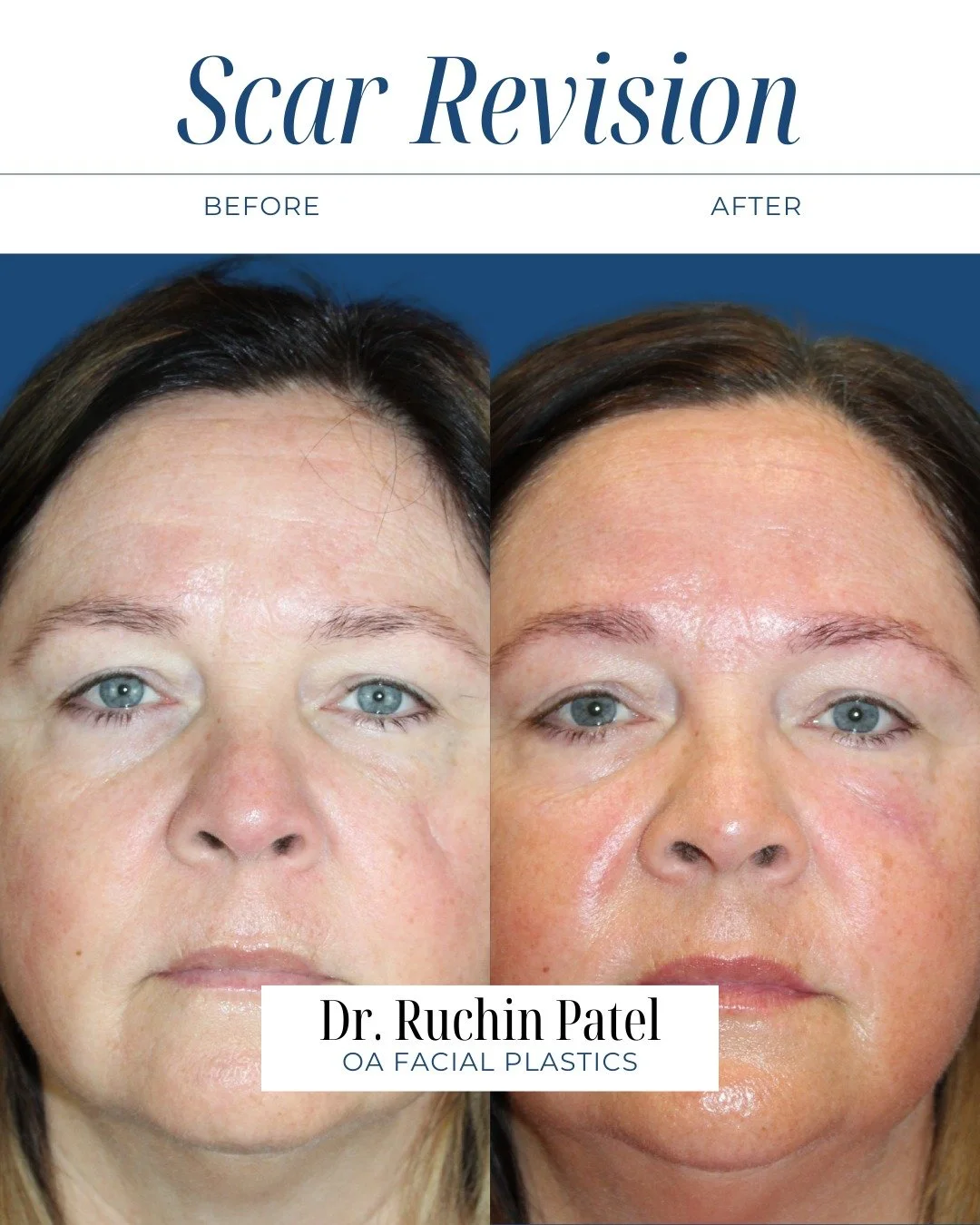 4 months after scar revision ✨

Early healing typically involves mild redness and tenderness for 1&ndash;2 weeks, but full scar maturation takes time&mdash;often several months to up to a year. 

The goal isn&rsquo;t to erase a scar completely. It&rs