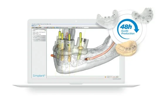 Digital dental implant planning software displayed on a laptop screen with 3D models of teeth and implants, indicating 48 hours guide production.