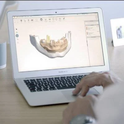 A person using a laptop displaying a 3D digital model of a human jawbone.