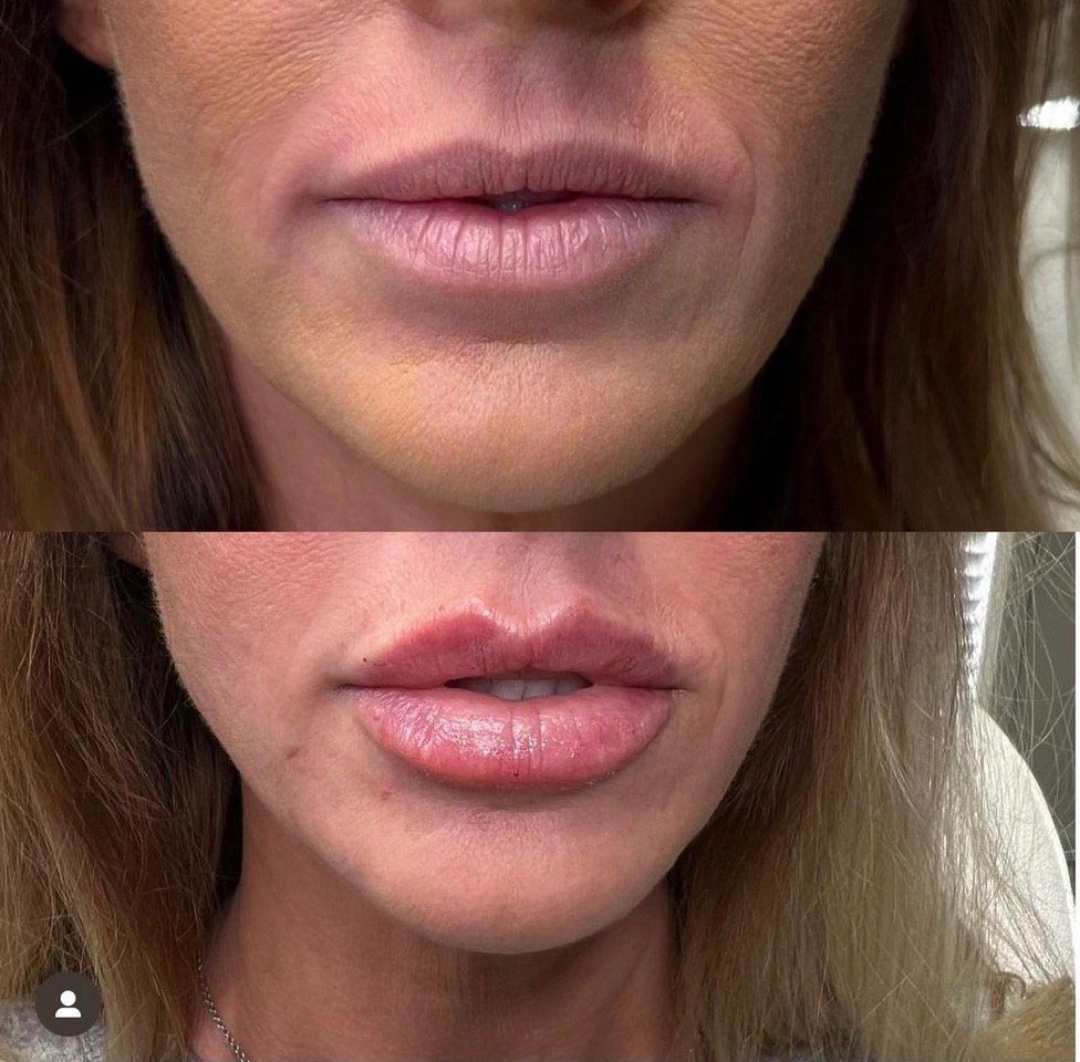 LIP FILLER BEFORE & AFTER