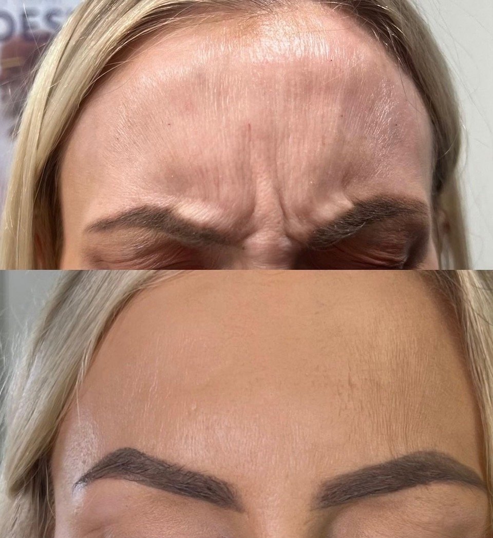 BOTOX BEFORE & AFTER