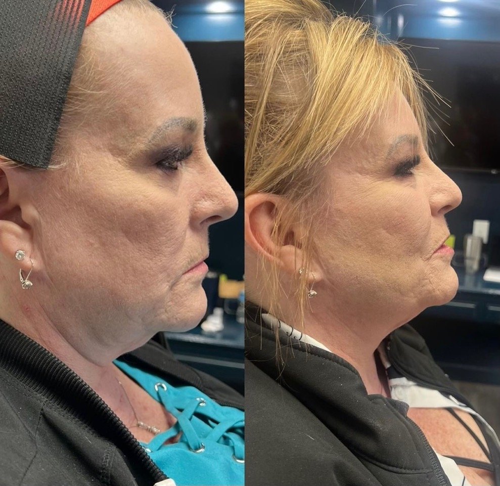 THREADS BEFORE & AFTER