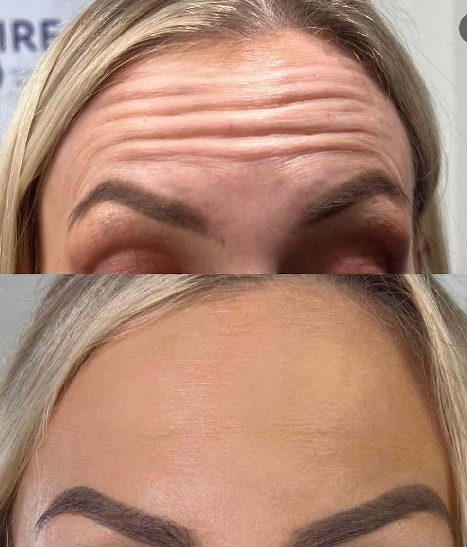 BOTOX BEFORE & AFTER