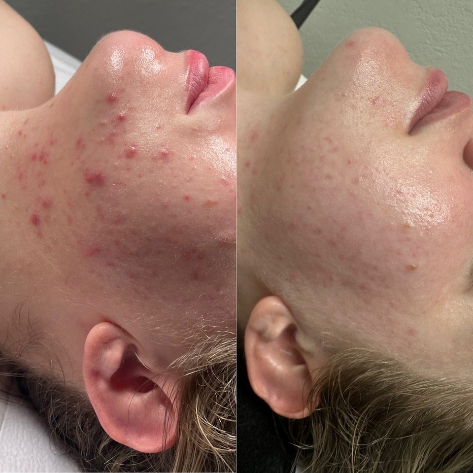 ACNE FACIAL BEFORE & AFTER