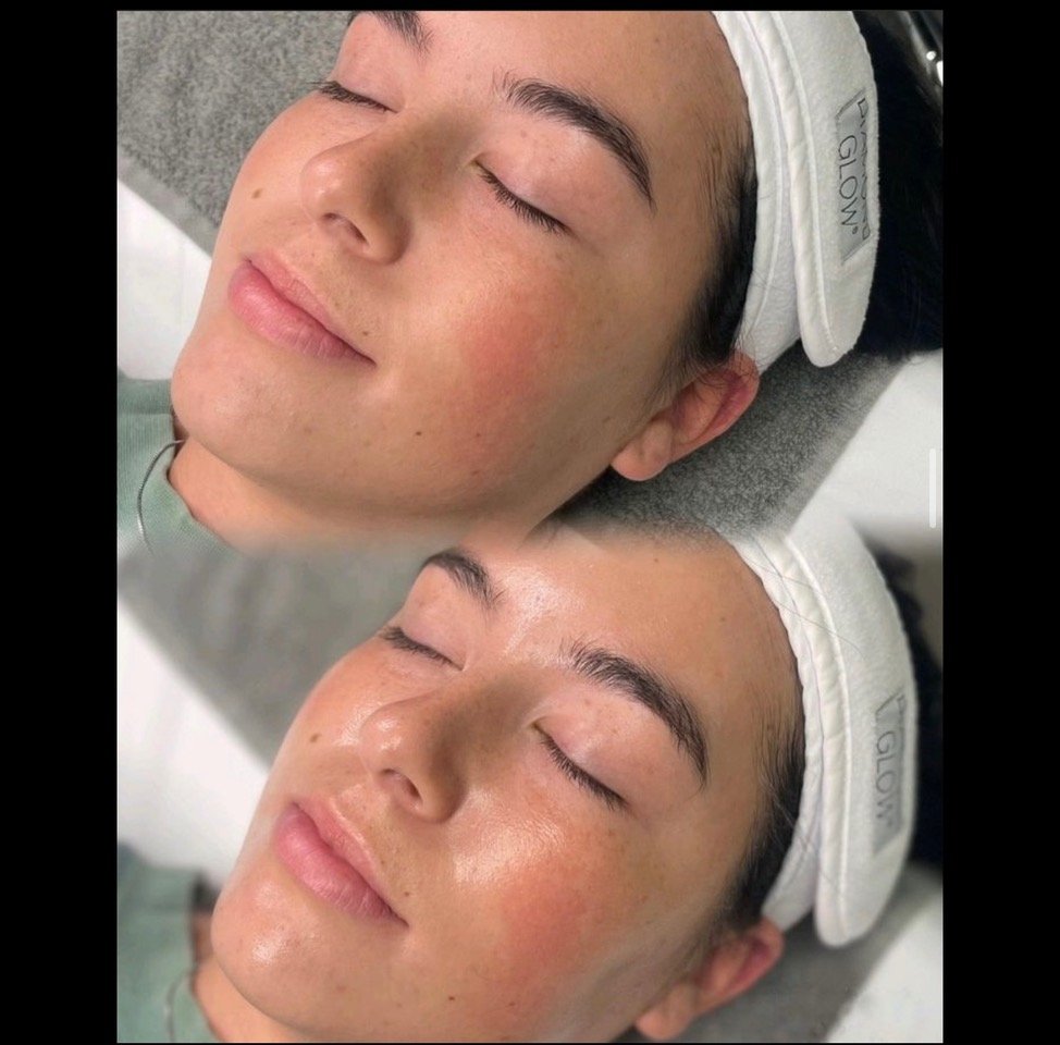 DERMAPLANE BEFORE & AFTER