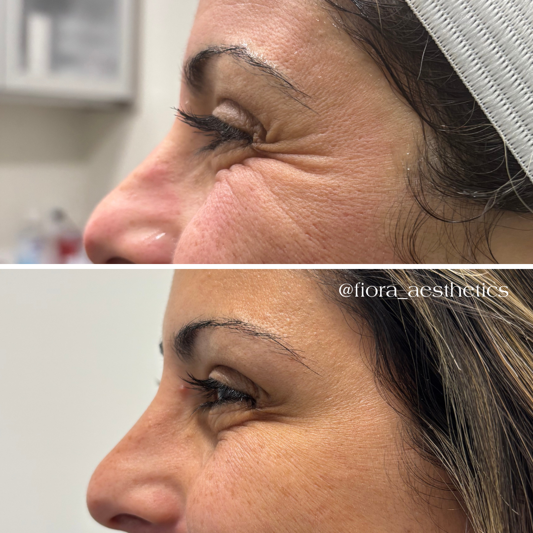 Why Botox Wears Off Fast (And How to Make It Last Longer)