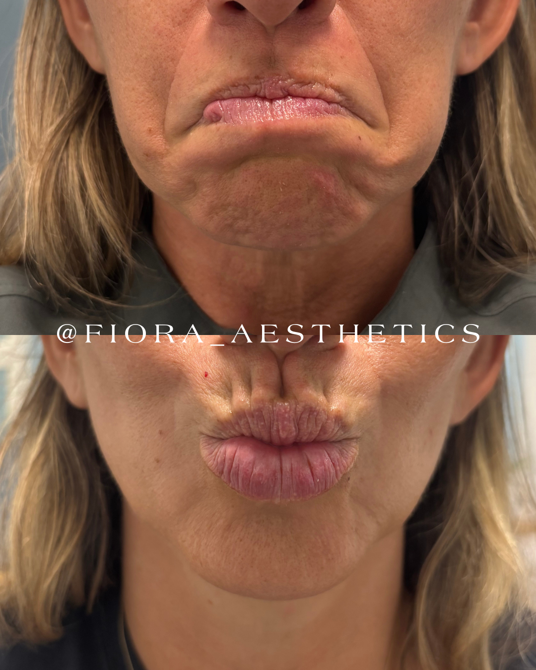Botox Is More Than Wrinkle Prevention: The Full-Face and Neck Lift You Didn't Know Botox Could Give You
