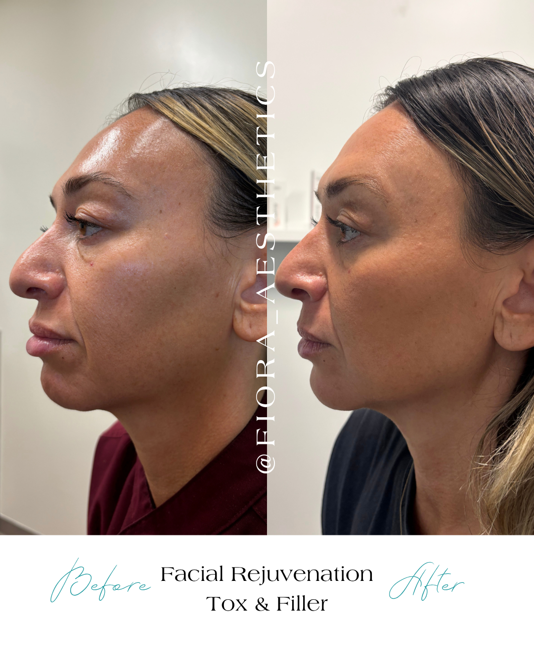 Why Sculptra Is the Best-Kept Secret for Natural, Long-Lasting Facial Rejuvenation (And Why We Love It)