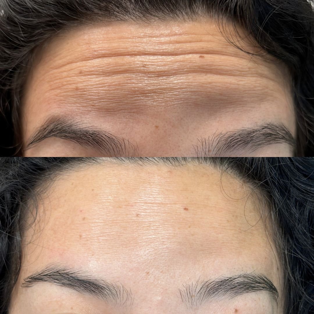 Fiora Aesthetics Botox Injection