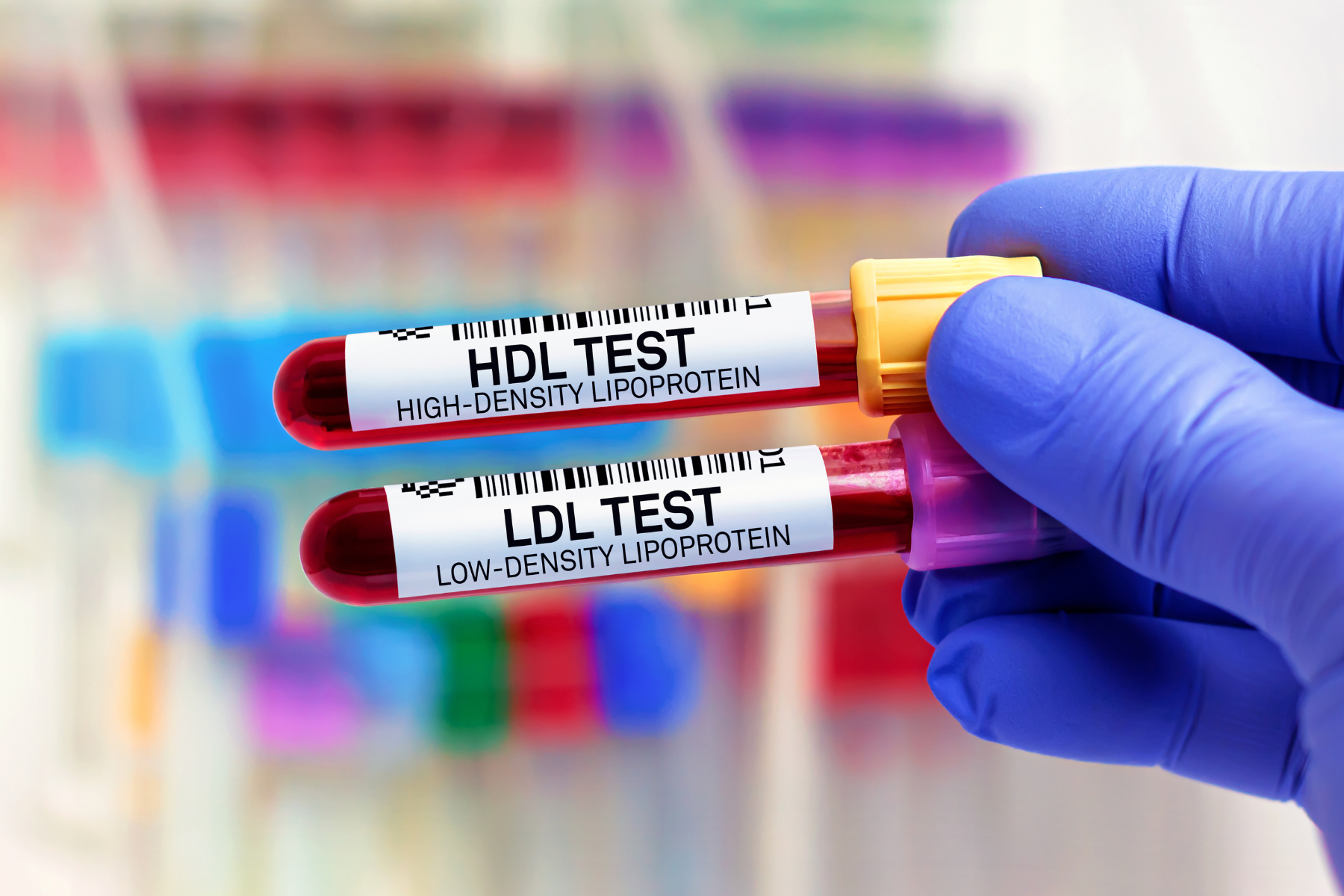 Cholesterol Is Not a Disease: Why We Should Be Looking at Sugar Instead