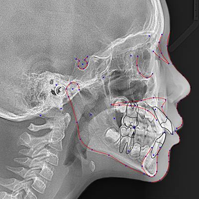 Lateral Cephalometric radiographic and tracing