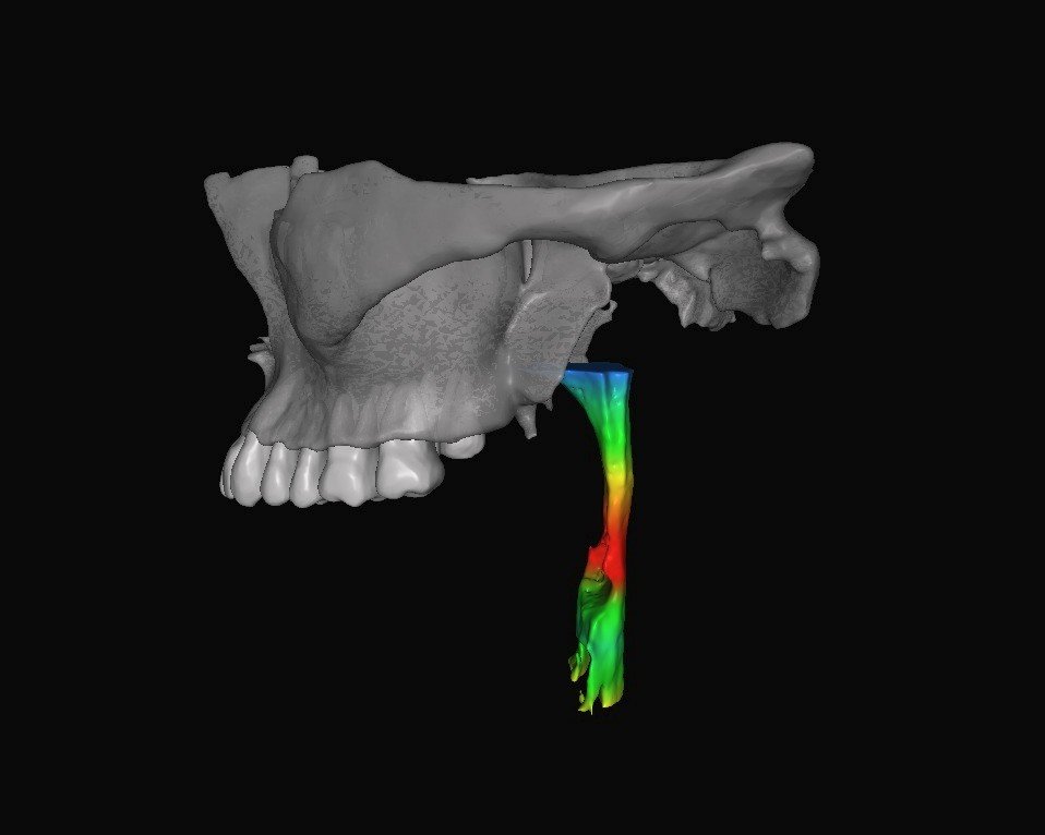 The role of Cone - Beam CT in the evaluation of airway obstructions and obstructive sleep apnea.