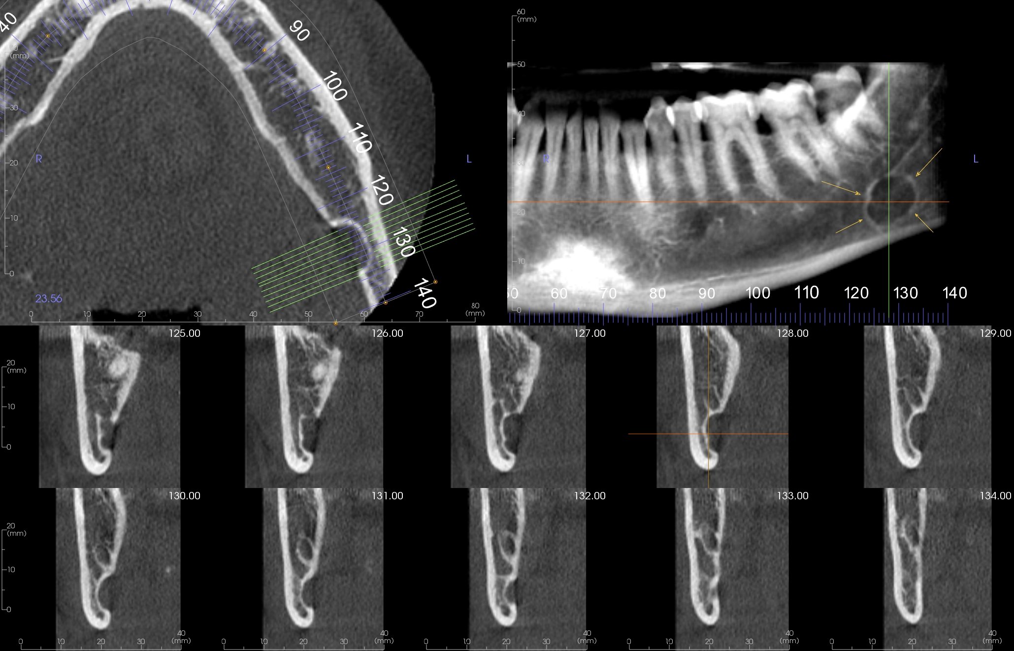 Radiographic appearance of a Stafne bone cyst.