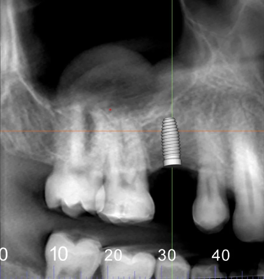 Visualization of virtual dental Implant Placement  in  Cone Beam CT image