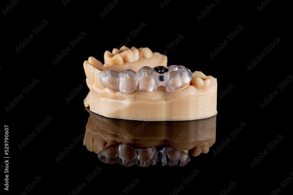 3D Printed dental model with surgical implant guide in place