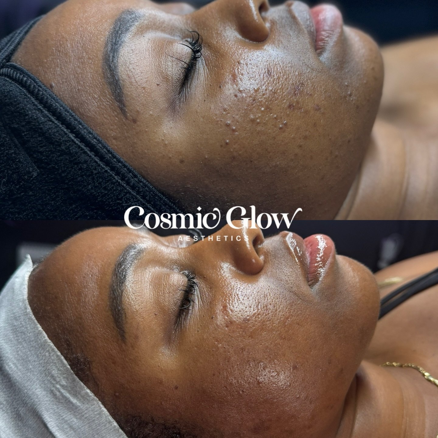 Clear skin in progress🚧

4 months with my angel client who was struggling with non-inflamed and inflamed breakouts. We&rsquo;re at the turning point with her skin where she is almost clear with just a few breakouts and now we can start really addres