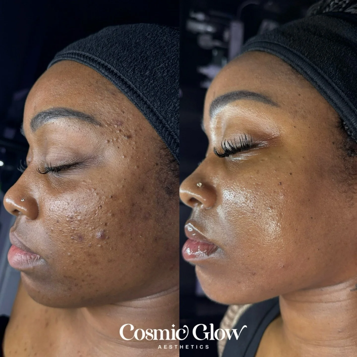 Oh hi🥹 Progress update on my client&rsquo;s skinnnnn. She&rsquo;s so consistent with her treatments/routine and I&rsquo;m so happy that she&rsquo;s happy💜