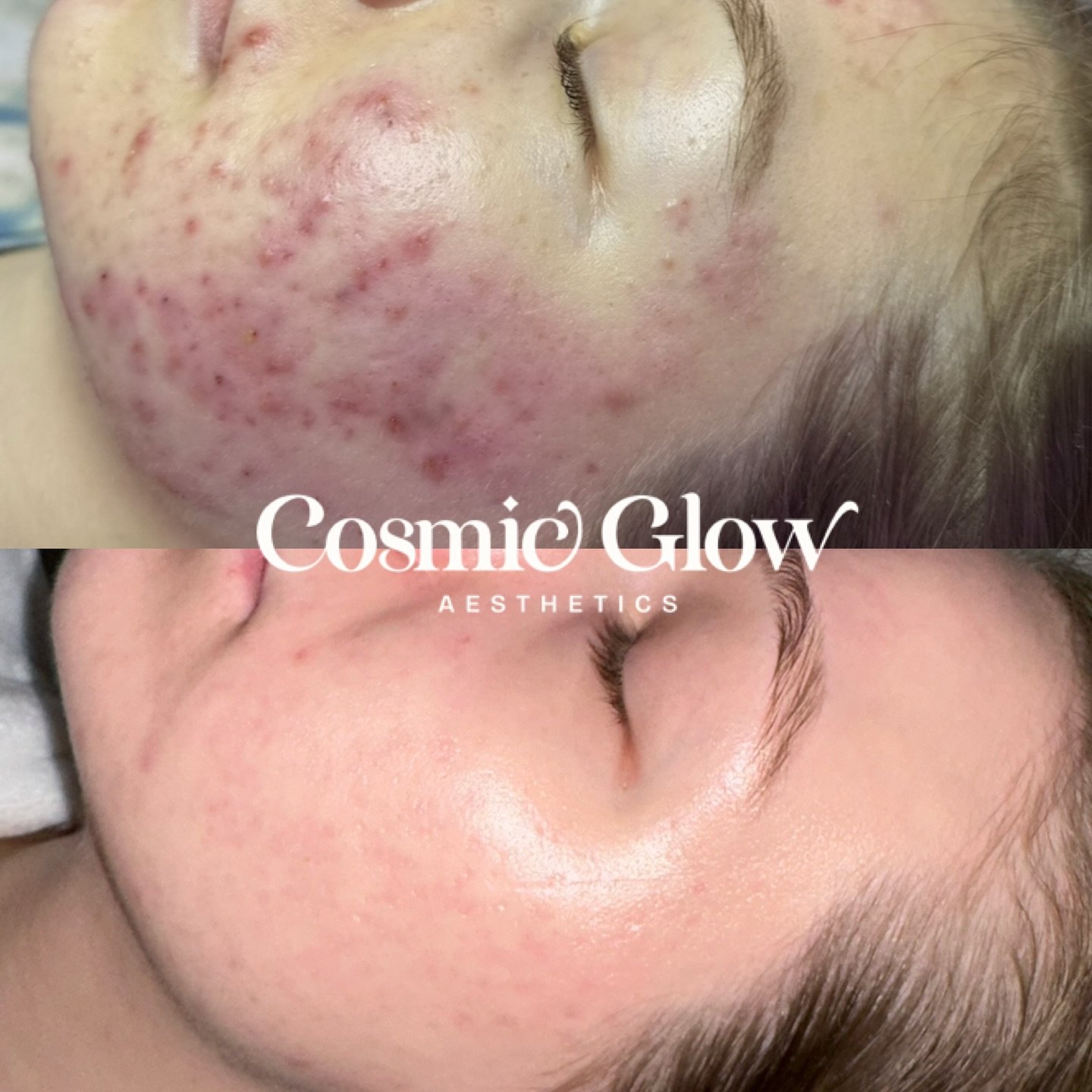 Healing acne is an art🖤👩🏻&zwj;🎨

I love reminiscing on some of my major transformations, they still bring me so much joy🥹 Every client I&rsquo;ve seen and been able to assist in their skin journey means so much to me. 

If you&rsquo;re experienc