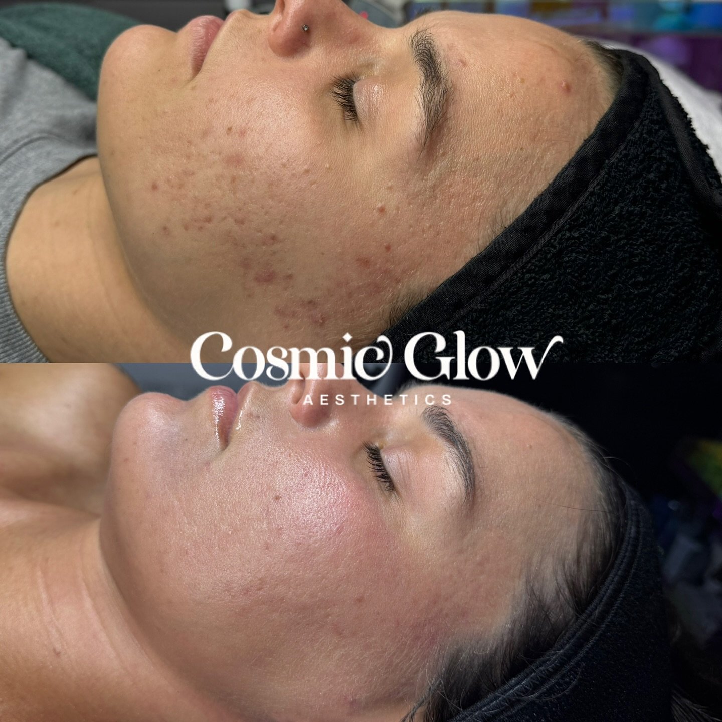 She let me clear her acne.. my dream date. Cute. 

#esthetician #acneexpert #skincare #hersheyesthetician #hersheypa #acne #loveisland