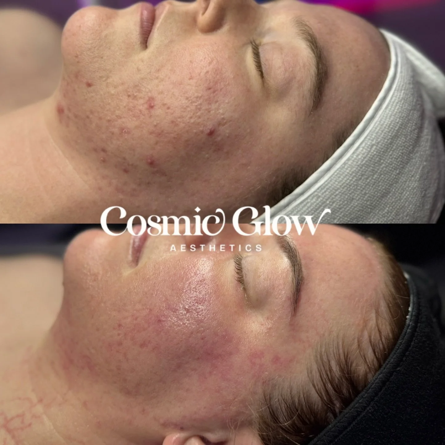 Oh the glow🥺💫 When I treat scarring with more intensive treatments, I love going back in with a DMK Enzyme to bring the skin into homeostasis. We are going to continue chipping away at her scarring while maintaining clear skin as she&rsquo;s prone 