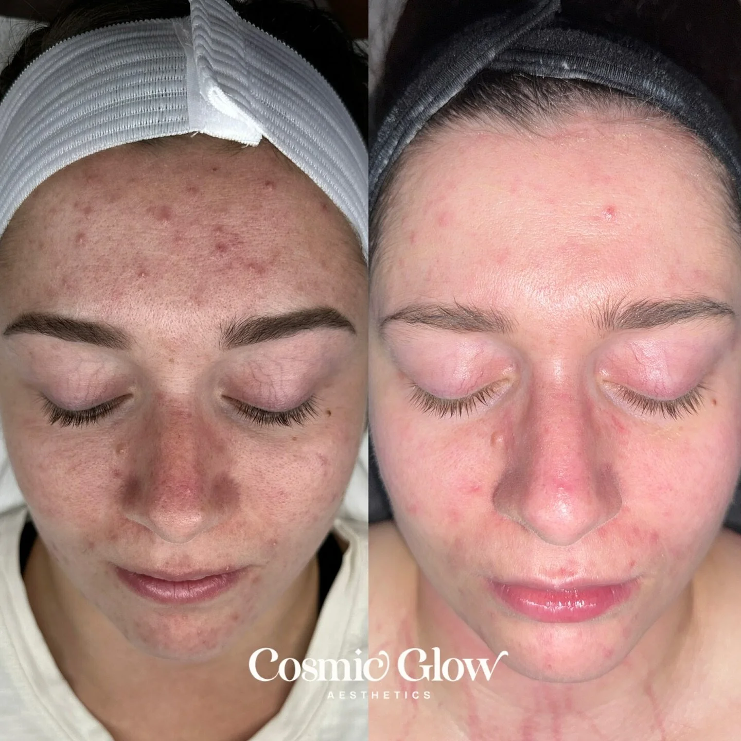 Swipe to see my beautiful client&rsquo;s progression of acne until now🥹

1st picture: Before pregnancy
2nd picture: Beginning of pregnancy, forehead pretty much cleared up but her chin was becoming aggravated. She was developing perioral dermatitis 