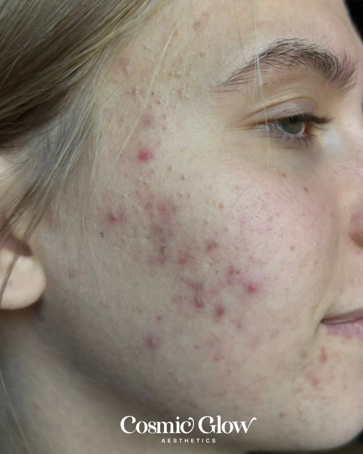 Before purging -> During purging -> After purging✨
Complete acne routine and 4 acne treatments apart🥹🤍

This is the truth when you come to an acne specialist- your skin is not where you want it to be and what you&rsquo;re doing currently is n