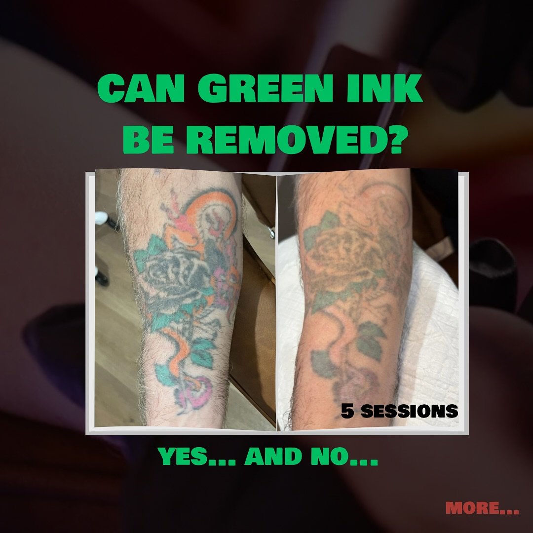 📍Holland Park, Brisbane Monday to Saturday - By Appointment Only &nbsp;#tattooremoval #tattooremovalresults #tattooremovalbrisbane #brisbanetattooremoval #brisbanetattoo #brisbanetattooartist #brisbanetattoos #tattooregret #brisbanebrows #brisbanebr