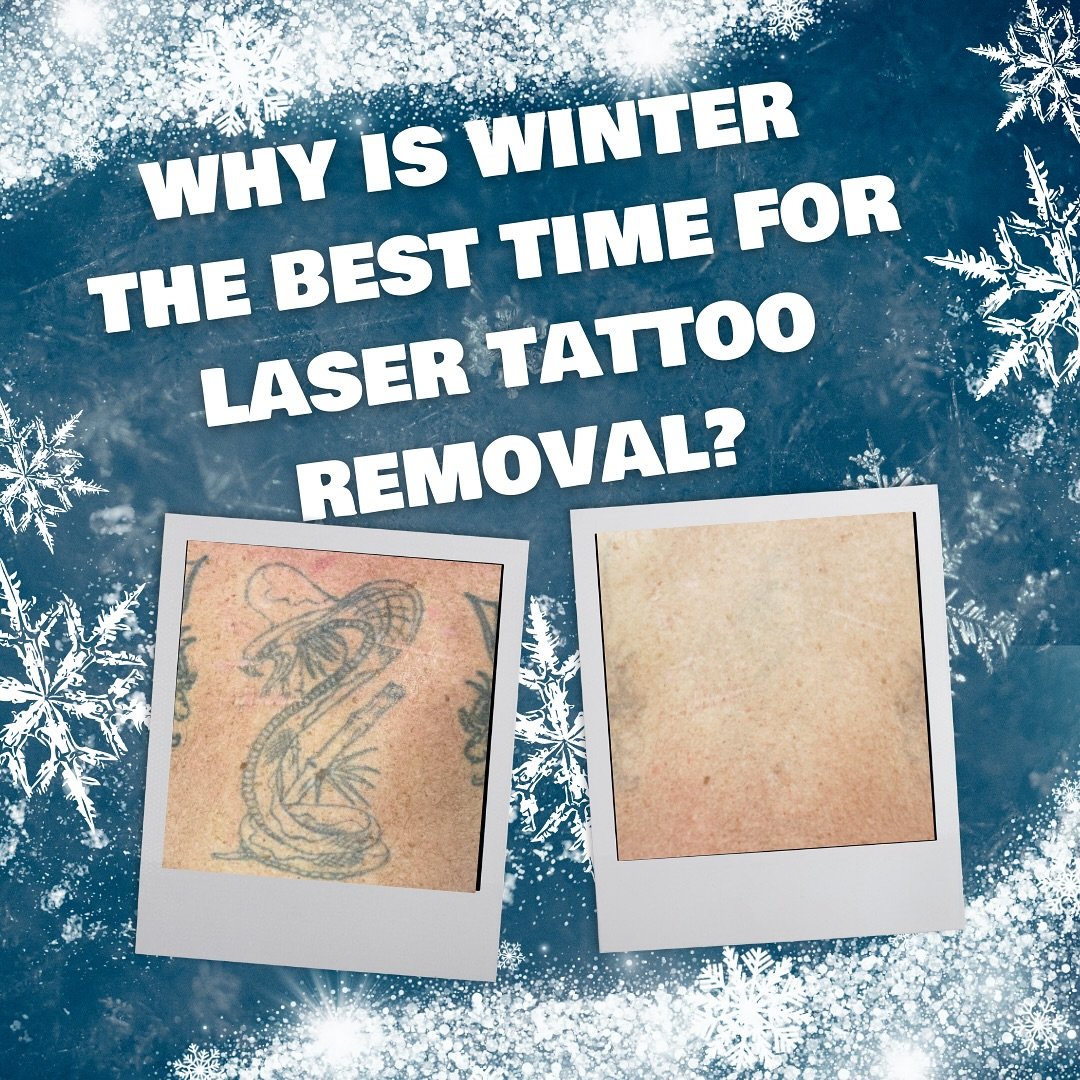 Why is winter the best time for laser tattoo removal? ❄️ Winter gives your skin the best chance to heal without the risk of sun exposure, which can make tattoo removal more effective and less risky. 🌞 With fewer chances of sunburn, your skin can rec