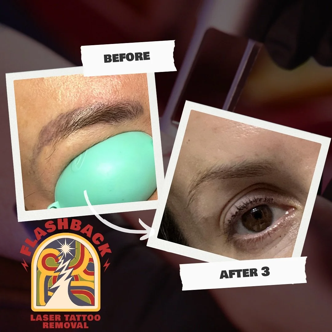 Still can’t believe this is the same wonderful woman’s brows. It is so exciting watching these transformations! 📍Holland Park, Brisbane Monday to Saturday - By Appointment Only  #tattooremoval #tattooremovalresults #tattooremovalbri